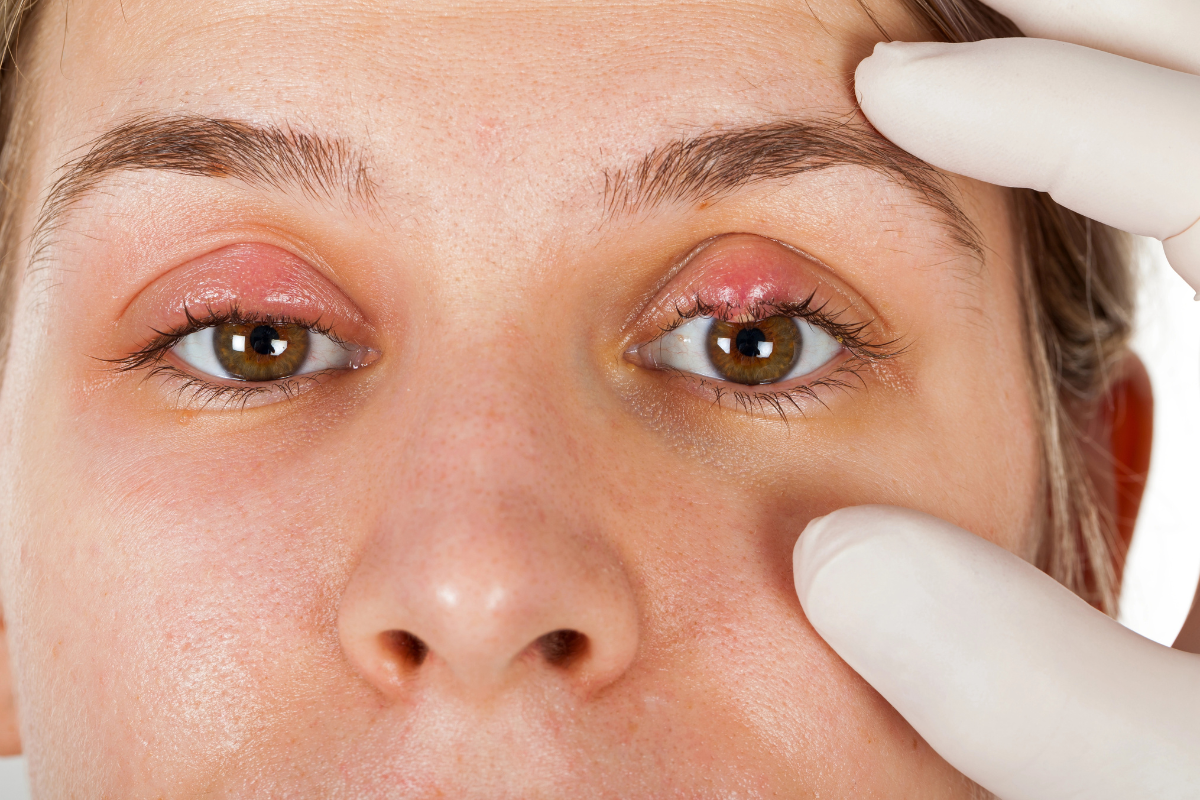 Blepharitis and Stye Treatment: Top Remedies for Relief