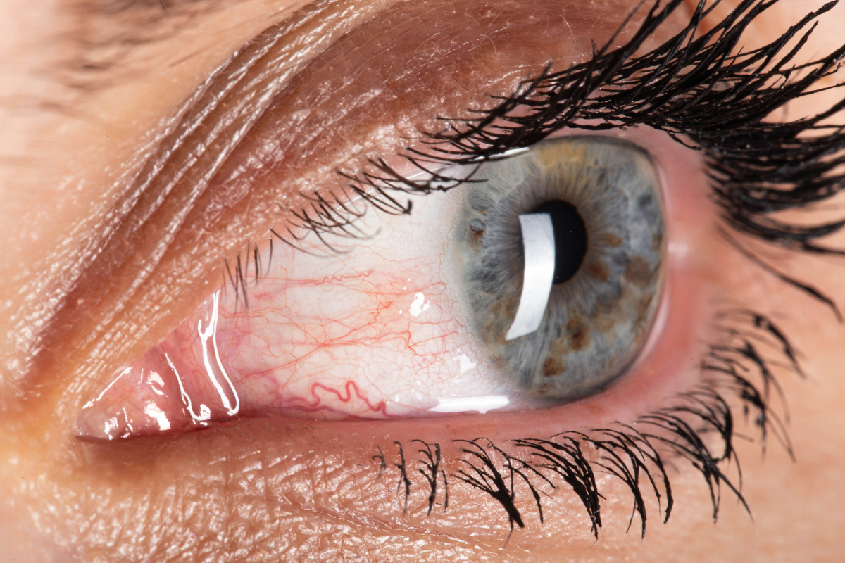 Can Stress Cause Dry Eyes and What to Do About It