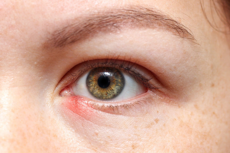 Chalazion Treatment - Eye Press
