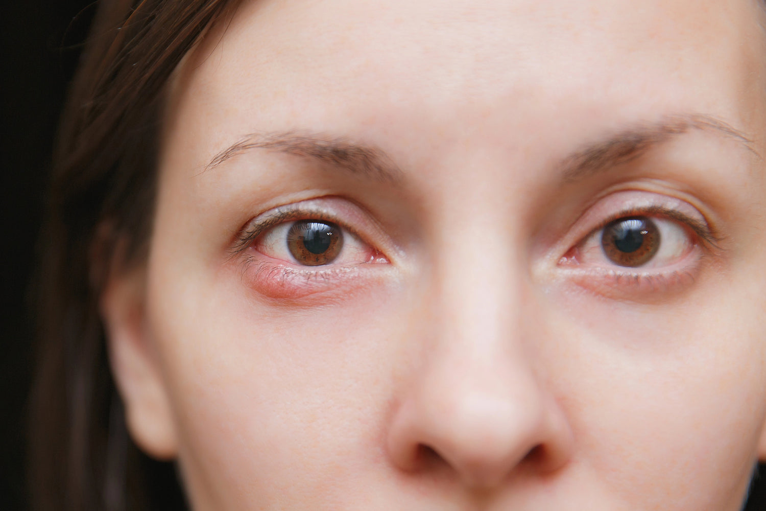 Women with Stye - Eye-Press
