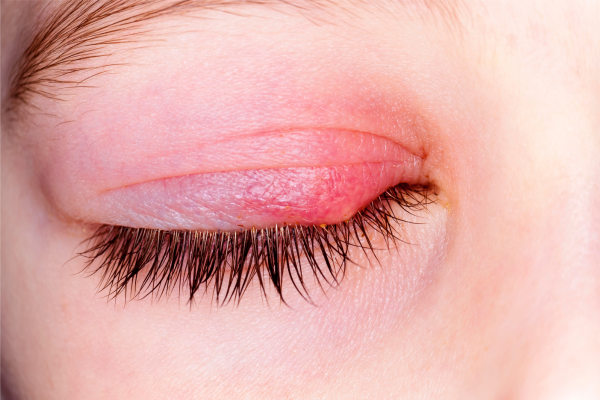 Eye Stye Closeup - Eye Press