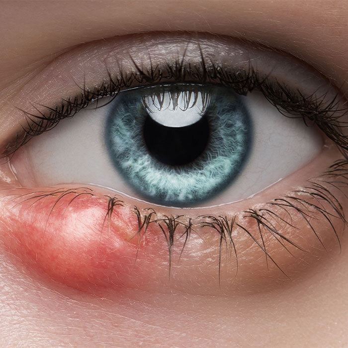 Blepharitis Treatment - Eye-Press