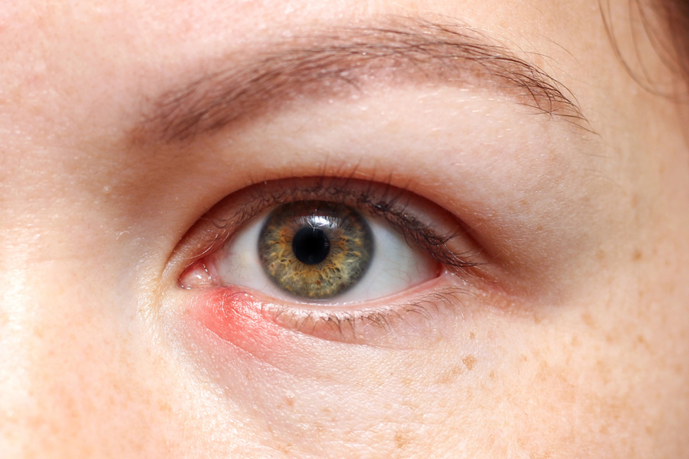 Chalazion Treatment Made Simple: The Power of Consistent Warm Compress Therapy