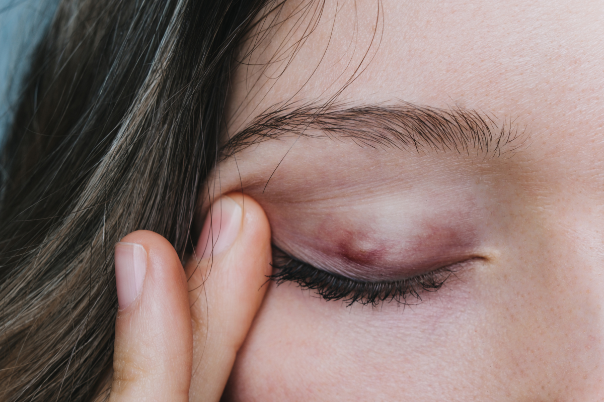 From Stye to Chalazion: Why Some Eyelid Bumps Harden Over Time