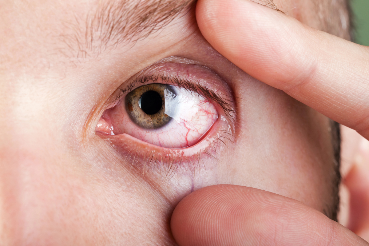 Do Dry Eyes Cause Styes? What You Should Know