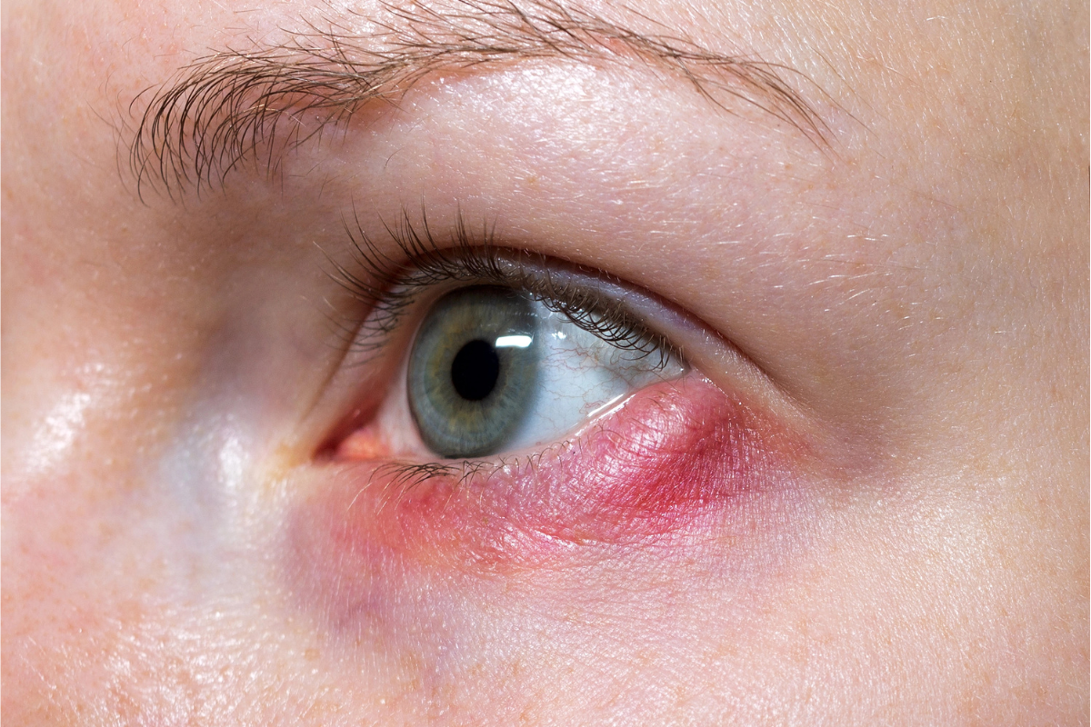 How Not Cleaning Your Eyelids Can Lead to Chronic Inflammation