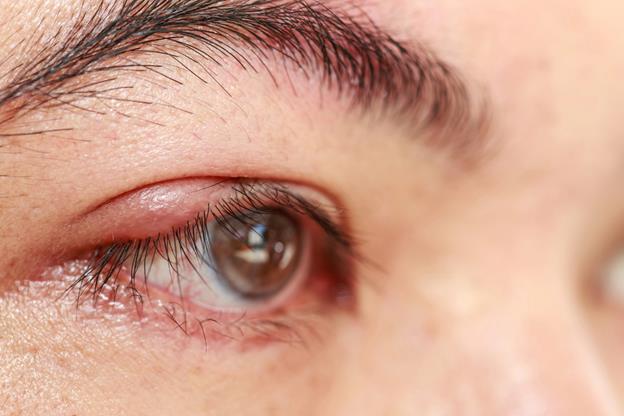 Warm Compress or Cold? Understanding Which Helps Eye Lumps Heal Faster