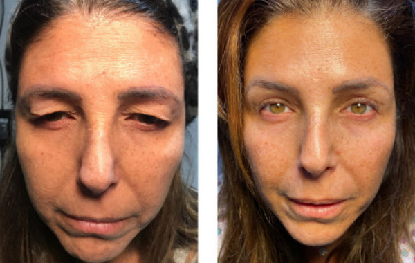 Best Treatments for Adult Blepharitis - Symptoms, Causes, and Eye Care with Eye-Press