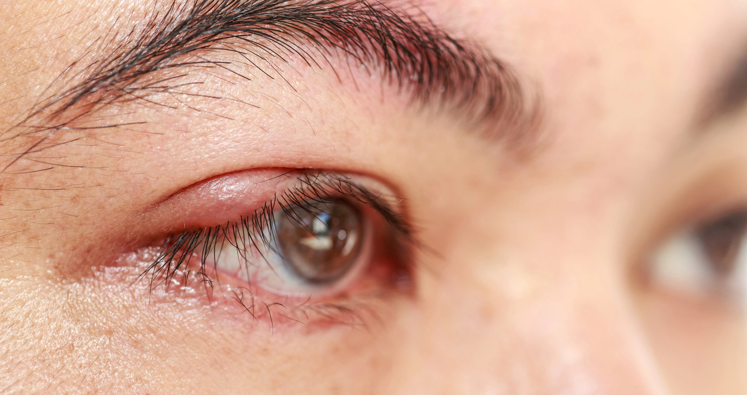 Eye Condition - Chalazion - Eye-Press