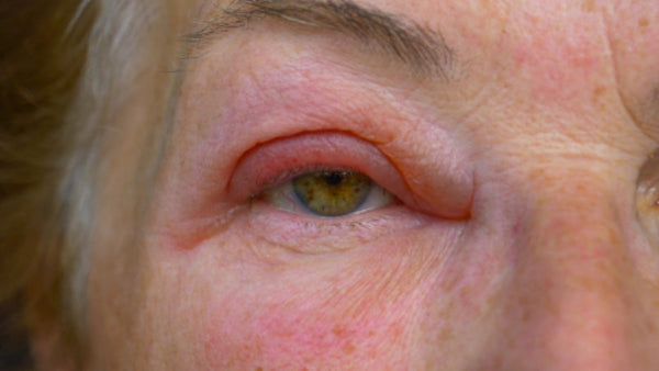 Eyelid Infections and Styes in Blepharitis - Eye Press
