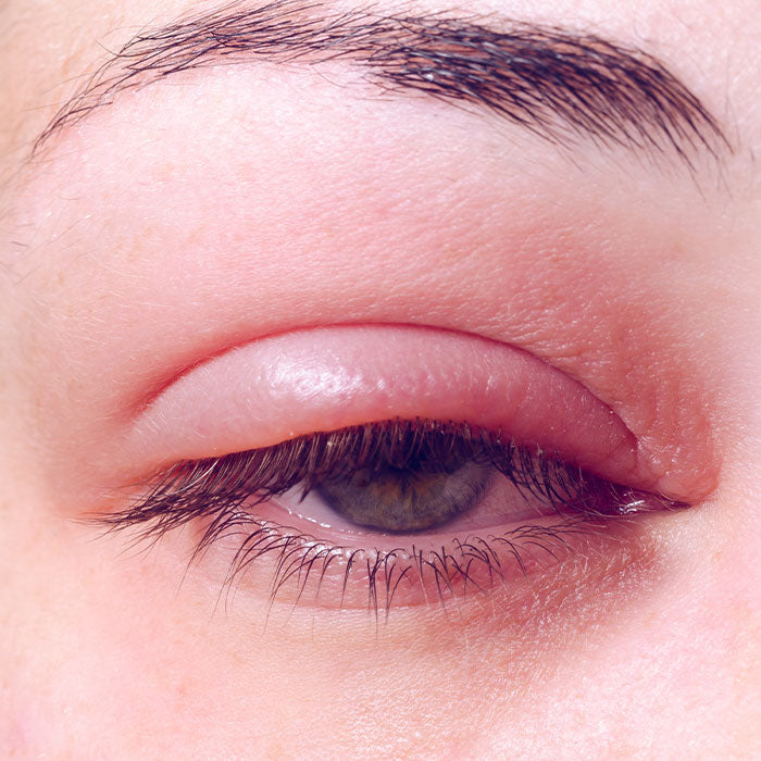 Blepharitis Treatment - Eye Press