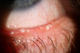 Meibomian Gland Dysfunction Treatment - Eye Press