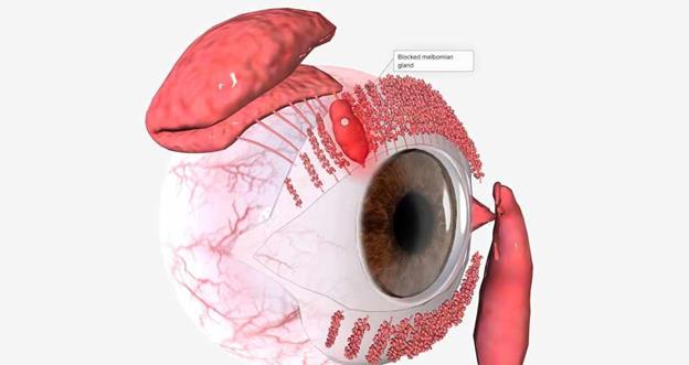 Meibomian Gland Dysfunction (MGD) Management with Eye-Press