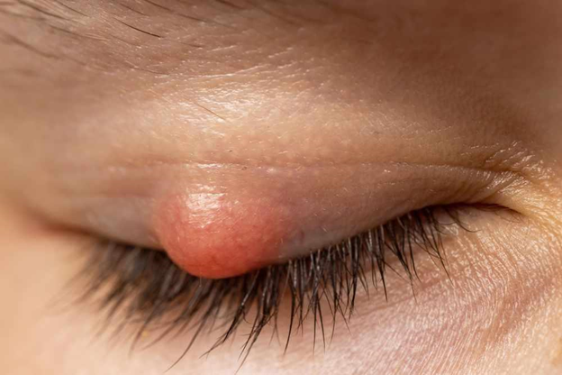 Chalazion Treatment Guide - Eye-Press